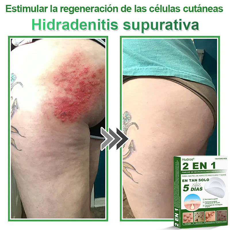𝐇𝐮𝐝𝐫𝐨𝐬® 📌𝐏𝐚𝐫𝐜𝐡𝐞𝐬 𝐡𝐢𝐝𝐫𝐨𝐜𝐨𝐥𝐨𝐢𝐝𝐞𝐬 𝐜𝐨𝐧 𝐦𝐢𝐜𝐫𝐨𝐚𝐠𝐮𝐣𝐚𝐬 𝟐 𝐞𝐧 𝟏🛒 𝐄𝐬𝐩𝐞𝐜𝐢𝐚𝐥𝐦𝐞𝐧𝐭𝐞 𝐝𝐢𝐬𝐞ñ𝐚𝐝𝐨𝐬 𝐩𝐚𝐫𝐚 𝐞𝐥𝐢𝐦𝐢𝐧𝐚𝐫 𝐥𝐮𝐧𝐚𝐫𝐞𝐬 𝐞𝐥𝐞𝐯𝐚𝐝𝐨𝐬, 𝐚𝐜𝐧é, 𝐯𝐞𝐫𝐫𝐮𝐠𝐚𝐬 𝐩𝐥𝐚𝐧𝐚𝐬 𝐲 𝐩𝐫𝐨𝐭𝐮𝐛𝐞𝐫𝐚𝐧𝐜𝐢𝐚𝐬 𝐜𝐮𝐭á𝐧𝐞𝐚𝐬 | 𝐏𝐚𝐪𝐮𝐞𝐭𝐞 𝐝𝐞 𝟏𝟒𝟒 𝐮𝐧𝐢𝐝𝐚𝐝𝐞𝐬🌳🌳