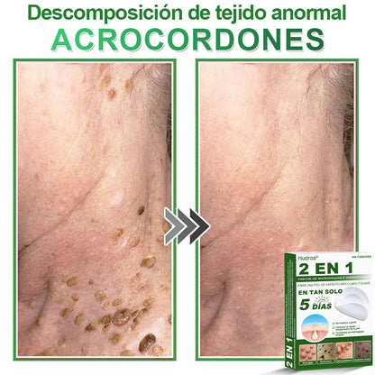 𝐇𝐮𝐝𝐫𝐨𝐬® 📌𝐏𝐚𝐫𝐜𝐡𝐞𝐬 𝐡𝐢𝐝𝐫𝐨𝐜𝐨𝐥𝐨𝐢𝐝𝐞𝐬 𝐜𝐨𝐧 𝐦𝐢𝐜𝐫𝐨𝐚𝐠𝐮𝐣𝐚𝐬 𝟐 𝐞𝐧 𝟏🛒 𝐄𝐬𝐩𝐞𝐜𝐢𝐚𝐥𝐦𝐞𝐧𝐭𝐞 𝐝𝐢𝐬𝐞ñ𝐚𝐝𝐨𝐬 𝐩𝐚𝐫𝐚 𝐞𝐥𝐢𝐦𝐢𝐧𝐚𝐫 𝐥𝐮𝐧𝐚𝐫𝐞𝐬 𝐞𝐥𝐞𝐯𝐚𝐝𝐨𝐬, 𝐚𝐜𝐧é, 𝐯𝐞𝐫𝐫𝐮𝐠𝐚𝐬 𝐩𝐥𝐚𝐧𝐚𝐬 𝐲 𝐩𝐫𝐨𝐭𝐮𝐛𝐞𝐫𝐚𝐧𝐜𝐢𝐚𝐬 𝐜𝐮𝐭á𝐧𝐞𝐚𝐬 | 𝐏𝐚𝐪𝐮𝐞𝐭𝐞 𝐝𝐞 𝟏𝟒𝟒 𝐮𝐧𝐢𝐝𝐚𝐝𝐞𝐬🌳🌳