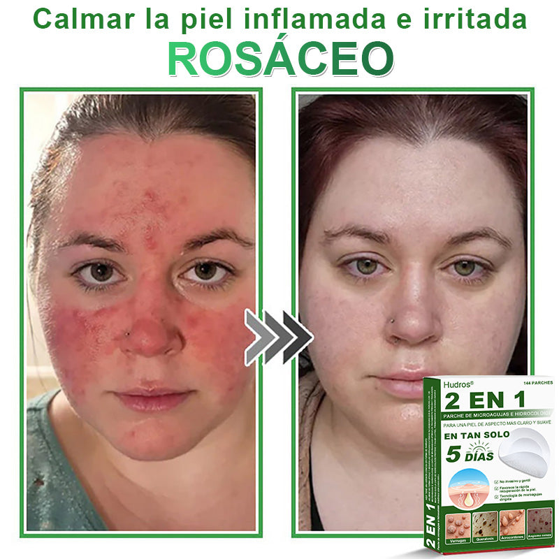 𝐇𝐮𝐝𝐫𝐨𝐬® 📌𝐏𝐚𝐫𝐜𝐡𝐞𝐬 𝐡𝐢𝐝𝐫𝐨𝐜𝐨𝐥𝐨𝐢𝐝𝐞𝐬 𝐜𝐨𝐧 𝐦𝐢𝐜𝐫𝐨𝐚𝐠𝐮𝐣𝐚𝐬 𝟐 𝐞𝐧 𝟏🛒 𝐄𝐬𝐩𝐞𝐜𝐢𝐚𝐥𝐦𝐞𝐧𝐭𝐞 𝐝𝐢𝐬𝐞ñ𝐚𝐝𝐨𝐬 𝐩𝐚𝐫𝐚 𝐞𝐥𝐢𝐦𝐢𝐧𝐚𝐫 𝐥𝐮𝐧𝐚𝐫𝐞𝐬 𝐞𝐥𝐞𝐯𝐚𝐝𝐨𝐬, 𝐚𝐜𝐧é, 𝐯𝐞𝐫𝐫𝐮𝐠𝐚𝐬 𝐩𝐥𝐚𝐧𝐚𝐬 𝐲 𝐩𝐫𝐨𝐭𝐮𝐛𝐞𝐫𝐚𝐧𝐜𝐢𝐚𝐬 𝐜𝐮𝐭á𝐧𝐞𝐚𝐬 | 𝐏𝐚𝐪𝐮𝐞𝐭𝐞 𝐝𝐞 𝟏𝟒𝟒 𝐮𝐧𝐢𝐝𝐚𝐝𝐞𝐬🌳🌳