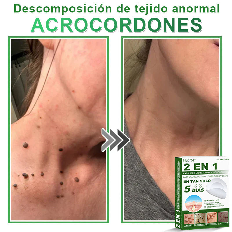 𝐇𝐮𝐝𝐫𝐨𝐬® 📌𝐏𝐚𝐫𝐜𝐡𝐞𝐬 𝐡𝐢𝐝𝐫𝐨𝐜𝐨𝐥𝐨𝐢𝐝𝐞𝐬 𝐜𝐨𝐧 𝐦𝐢𝐜𝐫𝐨𝐚𝐠𝐮𝐣𝐚𝐬 𝟐 𝐞𝐧 𝟏🛒 𝐄𝐬𝐩𝐞𝐜𝐢𝐚𝐥𝐦𝐞𝐧𝐭𝐞 𝐝𝐢𝐬𝐞ñ𝐚𝐝𝐨𝐬 𝐩𝐚𝐫𝐚 𝐞𝐥𝐢𝐦𝐢𝐧𝐚𝐫 𝐥𝐮𝐧𝐚𝐫𝐞𝐬 𝐞𝐥𝐞𝐯𝐚𝐝𝐨𝐬, 𝐚𝐜𝐧é, 𝐯𝐞𝐫𝐫𝐮𝐠𝐚𝐬 𝐩𝐥𝐚𝐧𝐚𝐬 𝐲 𝐩𝐫𝐨𝐭𝐮𝐛𝐞𝐫𝐚𝐧𝐜𝐢𝐚𝐬 𝐜𝐮𝐭á𝐧𝐞𝐚𝐬 | 𝐏𝐚𝐪𝐮𝐞𝐭𝐞 𝐝𝐞 𝟏𝟒𝟒 𝐮𝐧𝐢𝐝𝐚𝐝𝐞𝐬🌳🌳